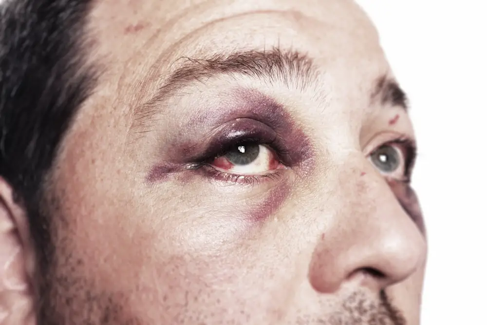 eye injury, male with black eye